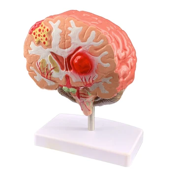 Simularea creierului uman boala model anatomia creierului neurochirurgie patologia creierului creierul patologie anatomică modelul medical