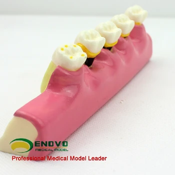 Modelul de clasificare orală boala parodontala